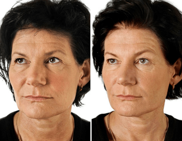 Het resultaat van de fractionele verjonging van het gezicht