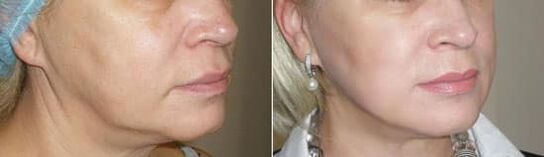 Foto na het toepassen van de procedure