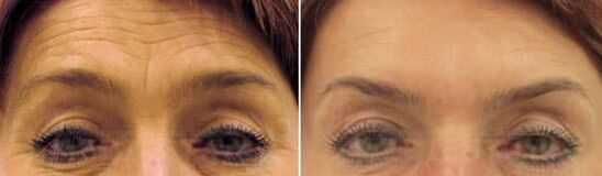 Veldverjonging van het voorhoofd